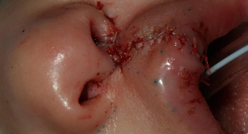 Closeup of a cleft lip