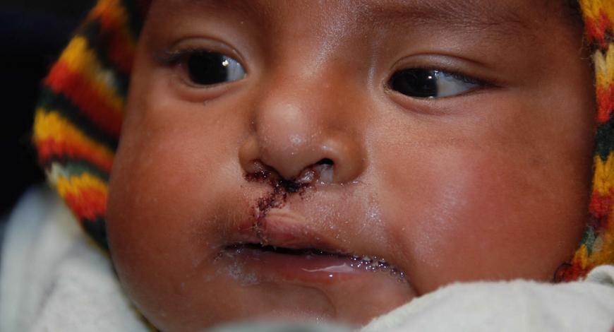 Baby with a repaired cleft lip