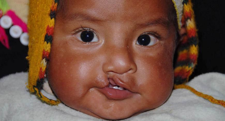 Close up of a baby with a cleft lip