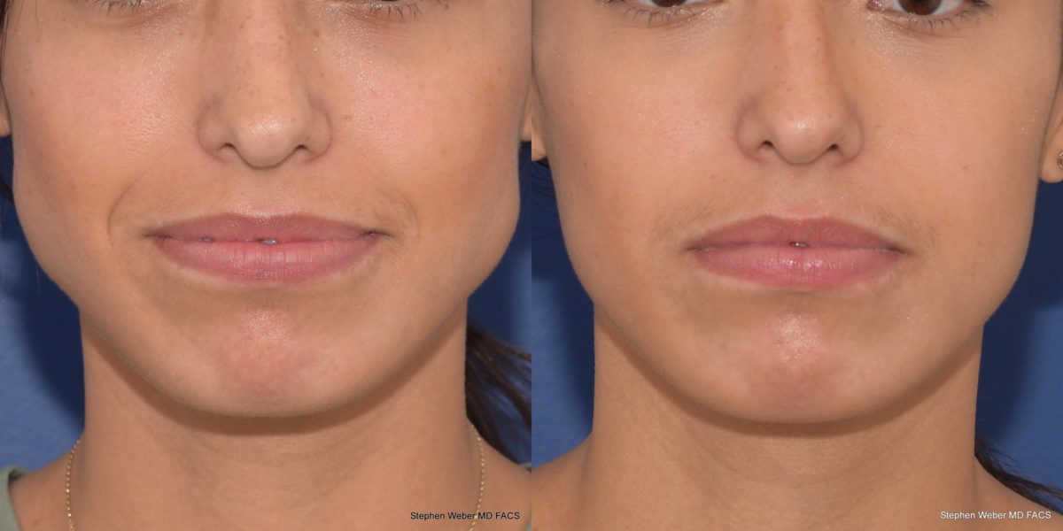 Botox Before and After | Weber Facial Plastic Surgery