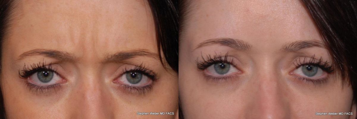 Botox Before and After | Weber Facial Plastic Surgery