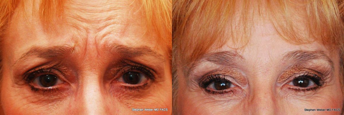 Botox Before and After | Weber Facial Plastic Surgery