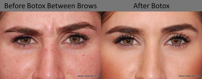 Botox Before and After | Weber Facial Plastic Surgery