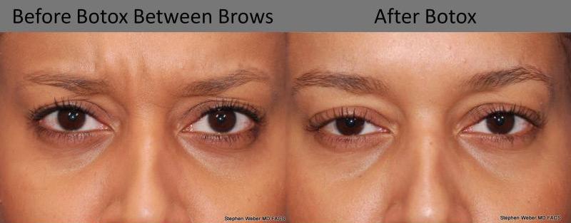 Botox Before and After | Weber Facial Plastic Surgery