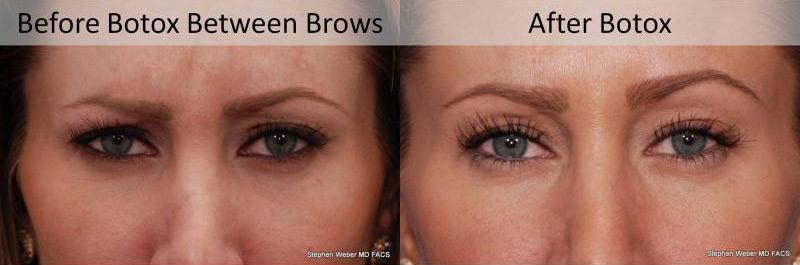 Botox Before and After | Weber Facial Plastic Surgery