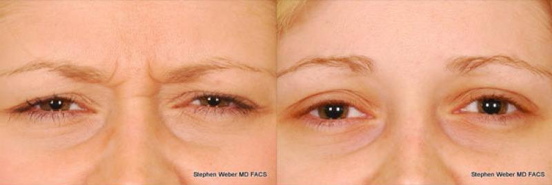 Botox Before and After | Weber Facial Plastic Surgery