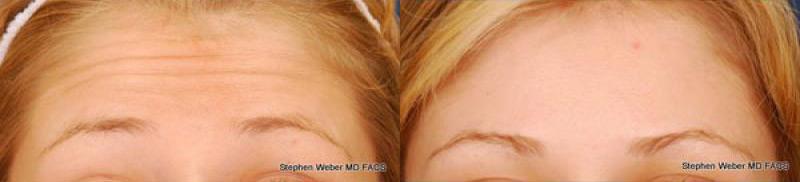 Botox Before and After | Weber Facial Plastic Surgery