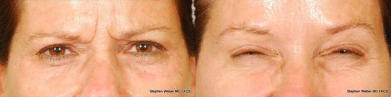 Botox Before and After | Weber Facial Plastic Surgery