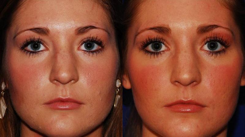 Botox Before and After | Weber Facial Plastic Surgery