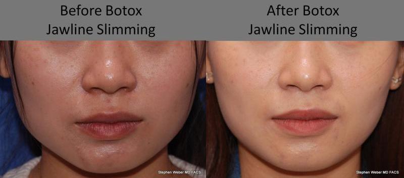Botox Before and After | Weber Facial Plastic Surgery