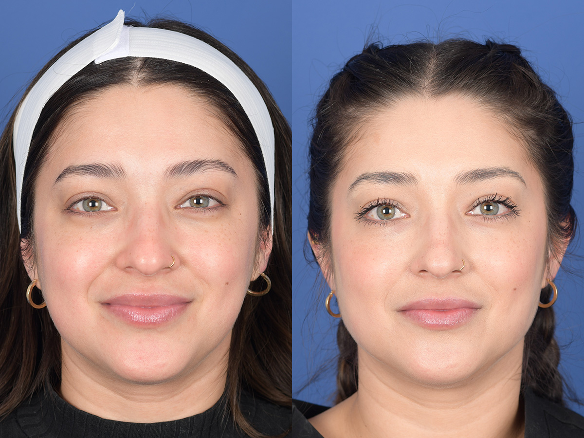 Dermal Filler Before and After | Weber Facial Plastic Surgery