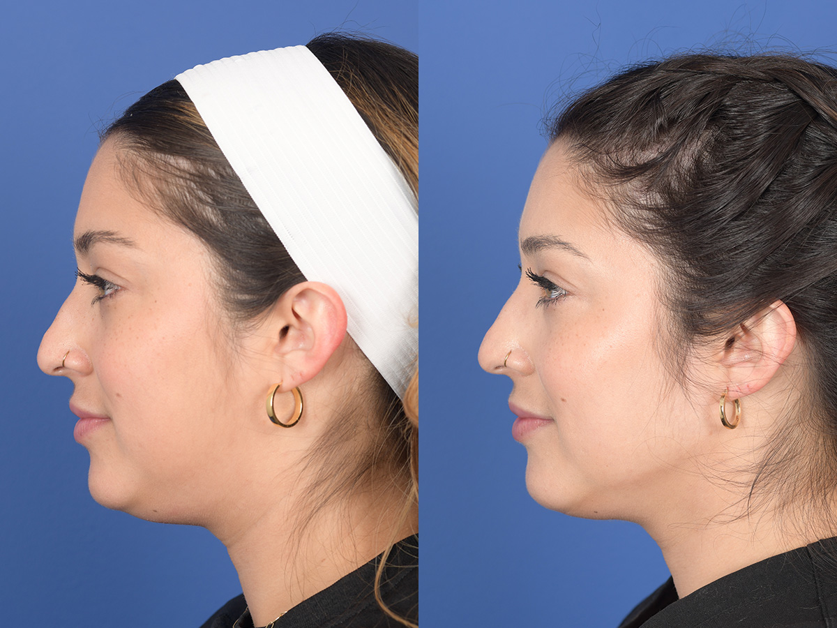 Dermal Filler Before and After | Weber Facial Plastic Surgery