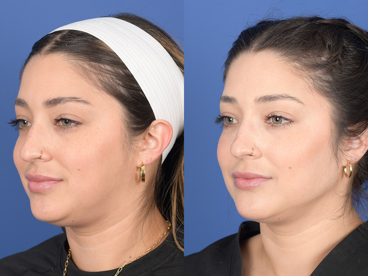 Dermal Filler Before and After | Weber Facial Plastic Surgery