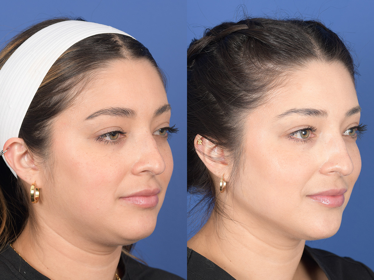 Dermal Filler Before and After | Weber Facial Plastic Surgery