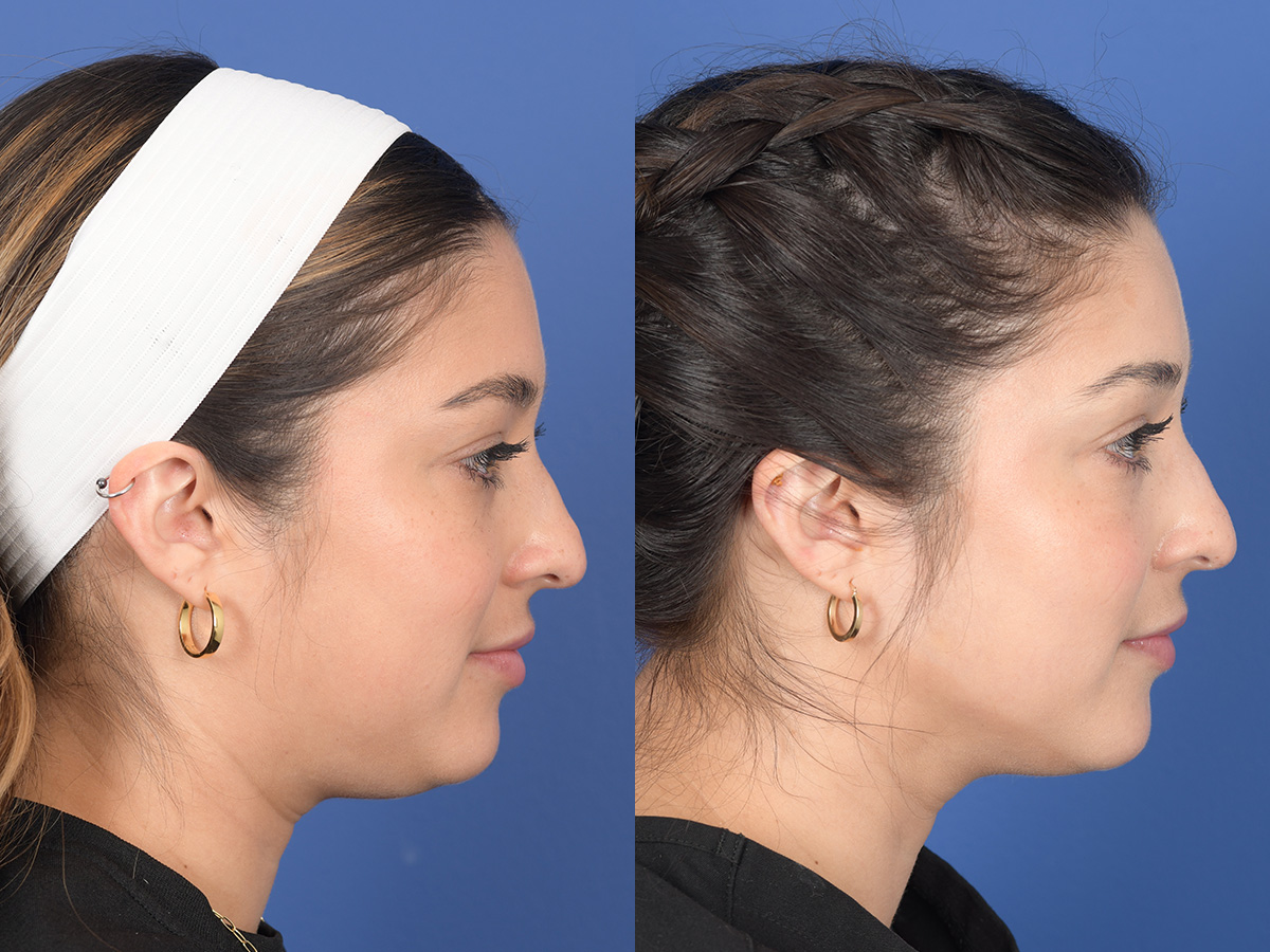 Dermal Filler Before and After | Weber Facial Plastic Surgery