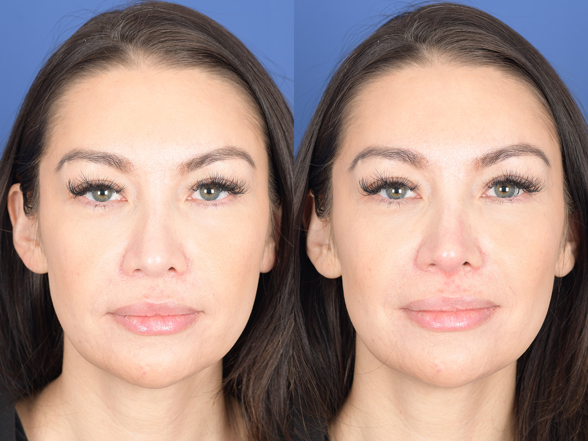 Dermal Filler Before and After | Weber Facial Plastic Surgery