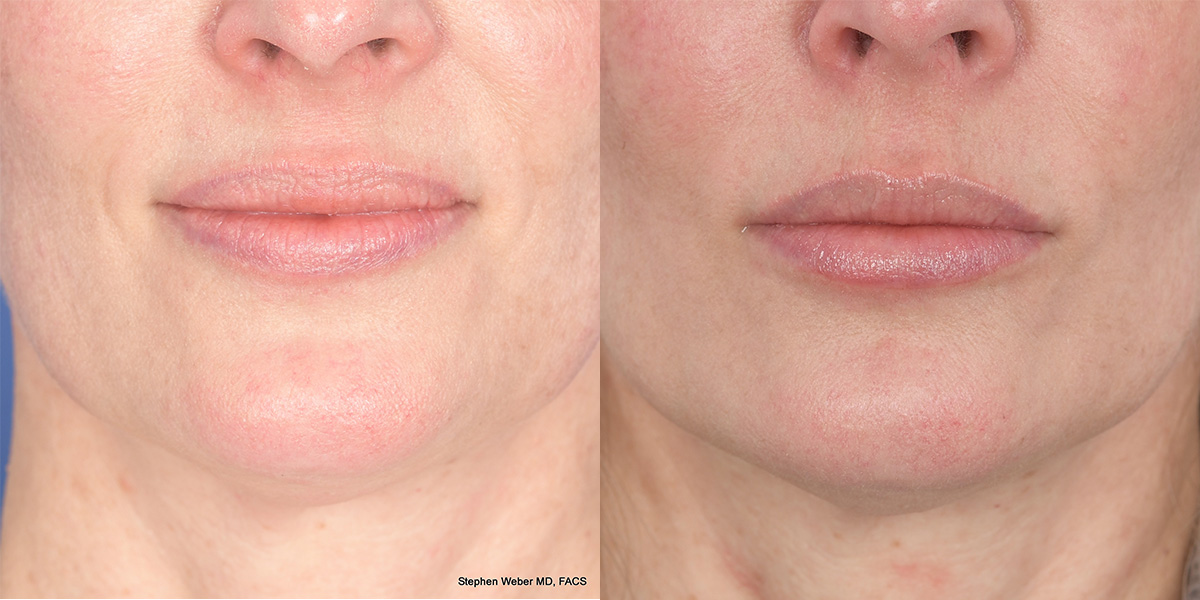 Dermal Filler Before and After | Weber Facial Plastic Surgery