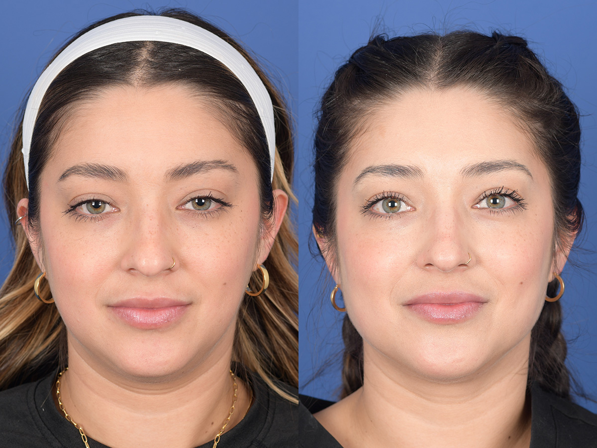 Dermal Filler Before and After | Weber Facial Plastic Surgery