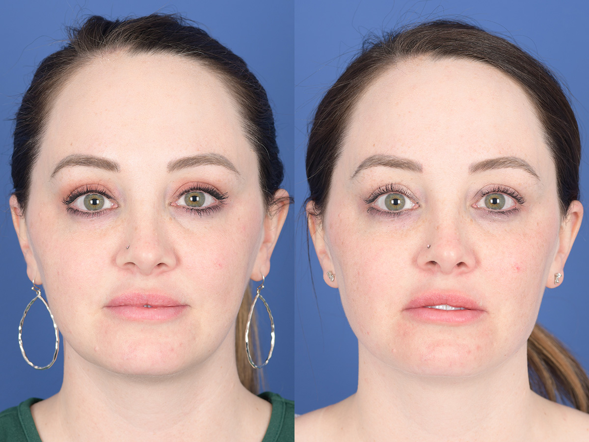 Dermal Filler Before and After | Weber Facial Plastic Surgery