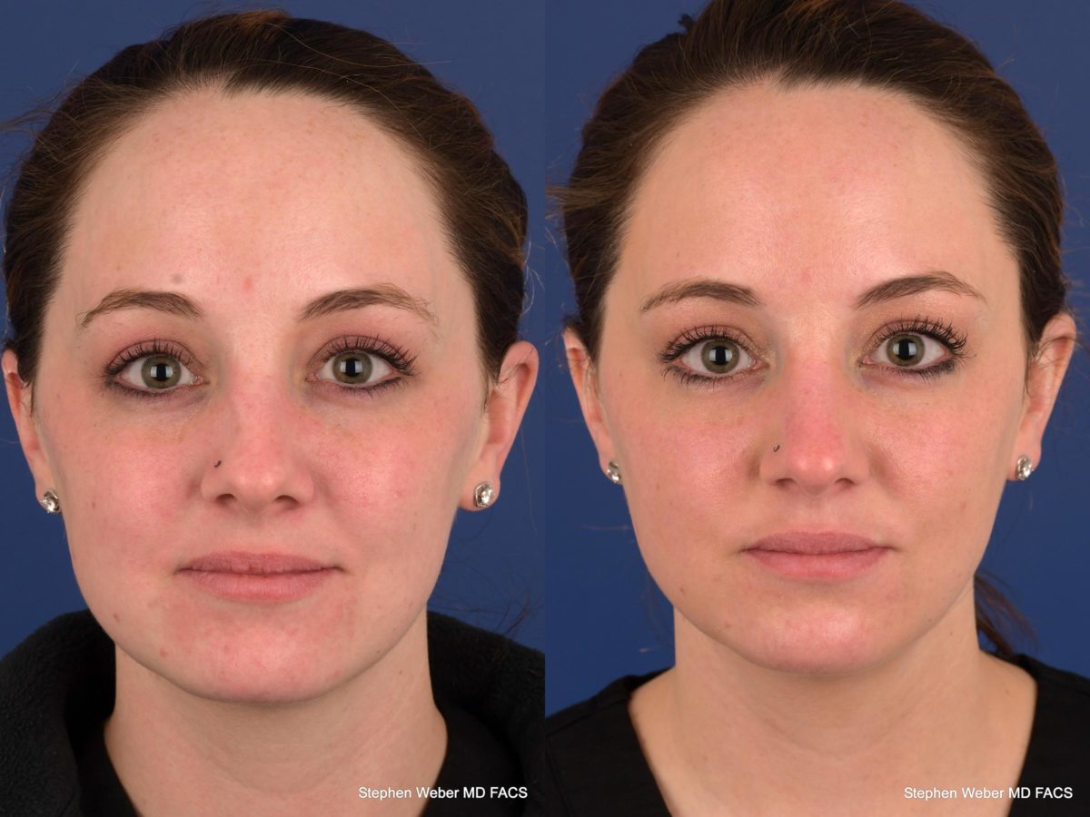 Dermal Filler Before and After | Weber Facial Plastic Surgery