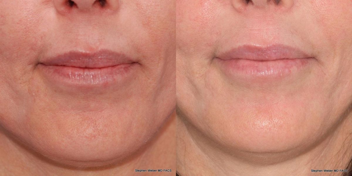 Dermal Filler Before and After | Weber Facial Plastic Surgery