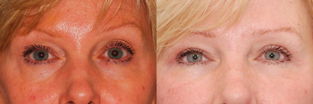 Dermal Filler Before and After | Weber Facial Plastic Surgery