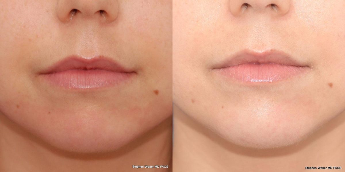 Dermal Filler Before and After | Weber Facial Plastic Surgery