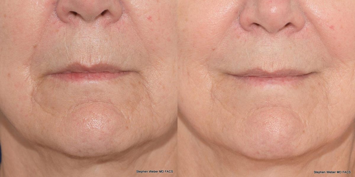 Dermal Filler Before and After | Weber Facial Plastic Surgery