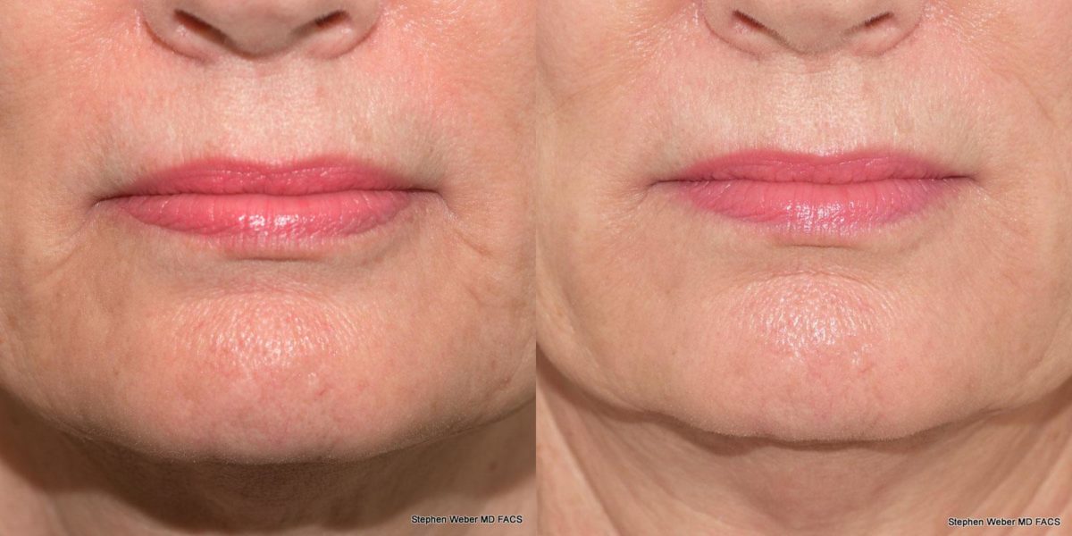 Dermal Filler Before and After | Weber Facial Plastic Surgery