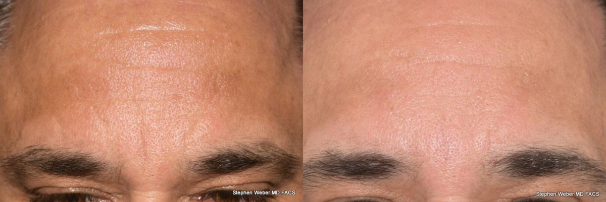 Dermal Filler Before and After | Weber Facial Plastic Surgery