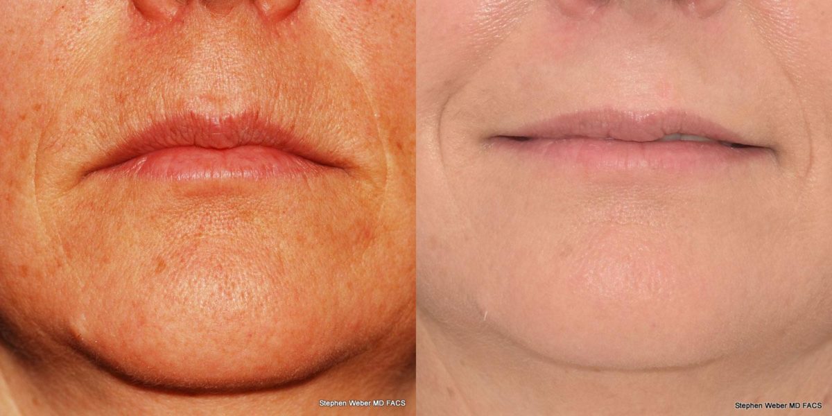 Dermal Filler Before and After | Weber Facial Plastic Surgery