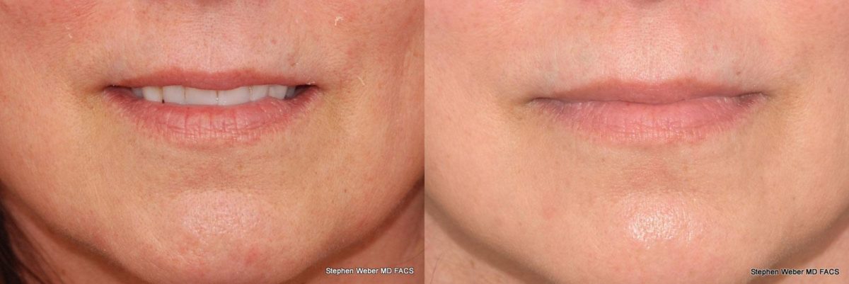 Dermal Filler Before and After | Weber Facial Plastic Surgery