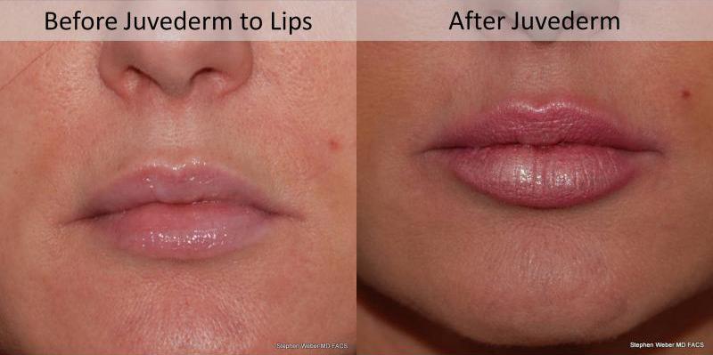 Dermal Filler Before and After | Weber Facial Plastic Surgery