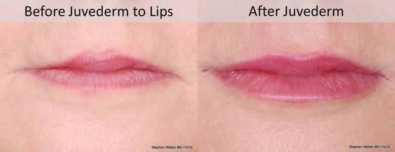 Dermal Filler Before and After | Weber Facial Plastic Surgery