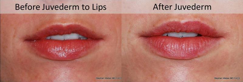 Dermal Filler Before and After | Weber Facial Plastic Surgery