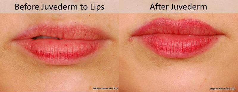 Dermal Filler Before and After | Weber Facial Plastic Surgery