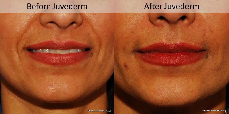 Dermal Filler Before and After | Weber Facial Plastic Surgery