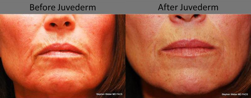 Dermal Filler Before and After | Weber Facial Plastic Surgery