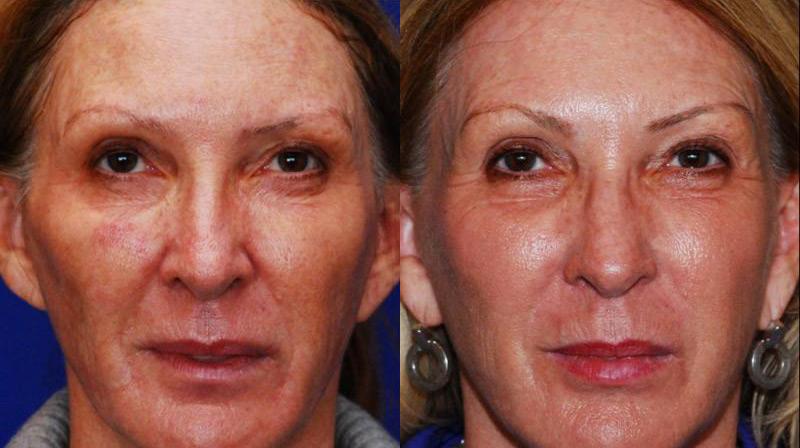 Dermal Filler Before and After | Weber Facial Plastic Surgery