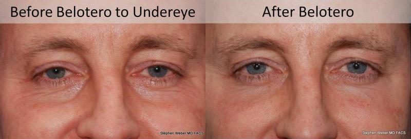 Dermal Filler Before and After | Weber Facial Plastic Surgery