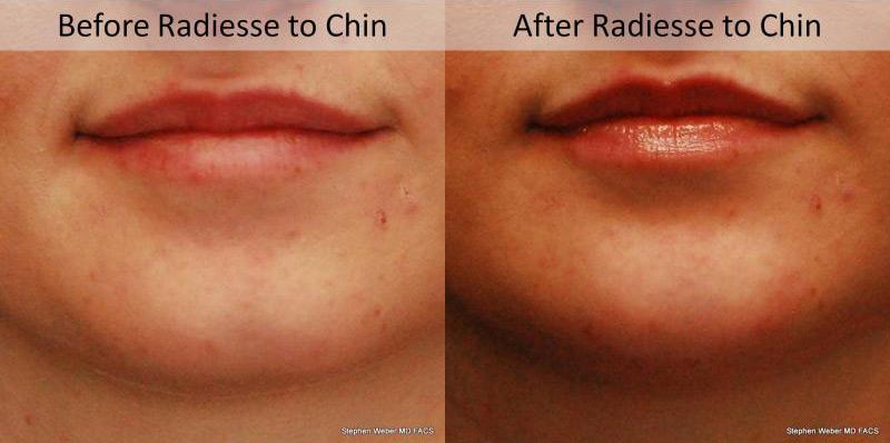 Dermal Filler Before and After | Weber Facial Plastic Surgery