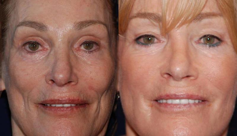Dermal Filler Before and After | Weber Facial Plastic Surgery