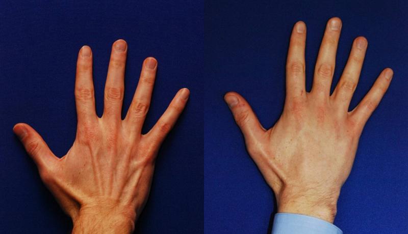 Dermal Filler Before and After | Weber Facial Plastic Surgery
