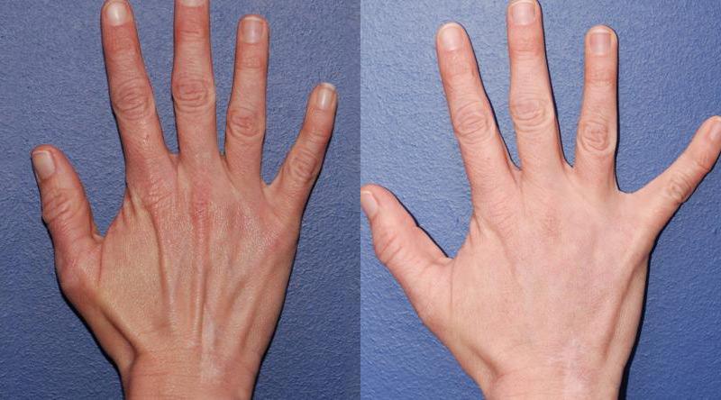 Dermal Filler Before and After | Weber Facial Plastic Surgery