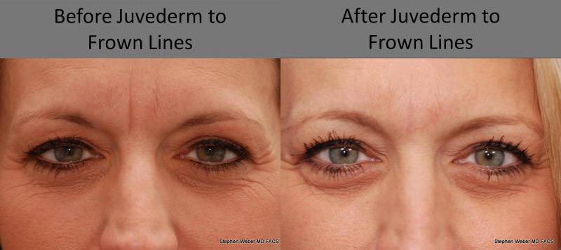Dermal Filler Before and After | Weber Facial Plastic Surgery