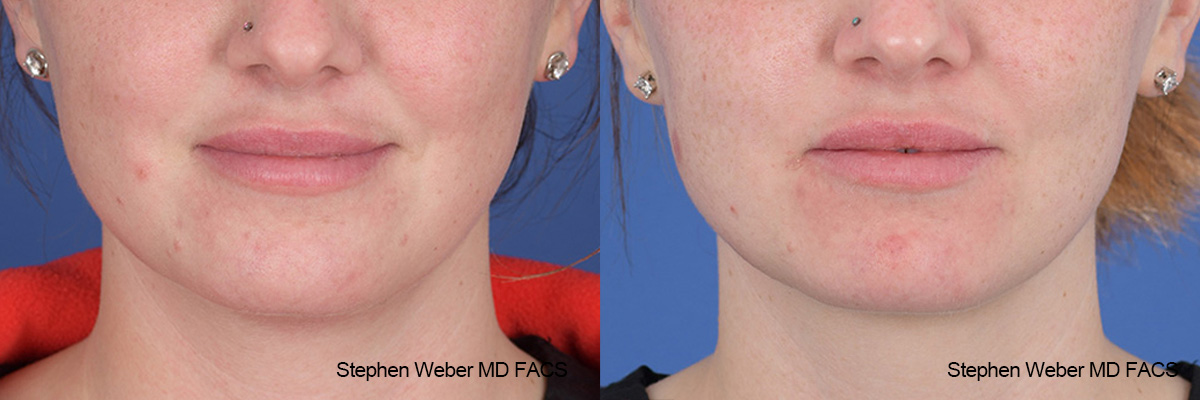 Kybella Before and After | Weber Facial Plastic Surgery