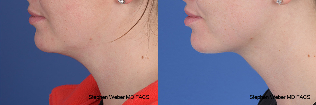 Kybella Before and After | Weber Facial Plastic Surgery