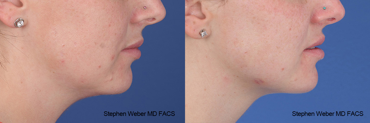Kybella Before and After | Weber Facial Plastic Surgery