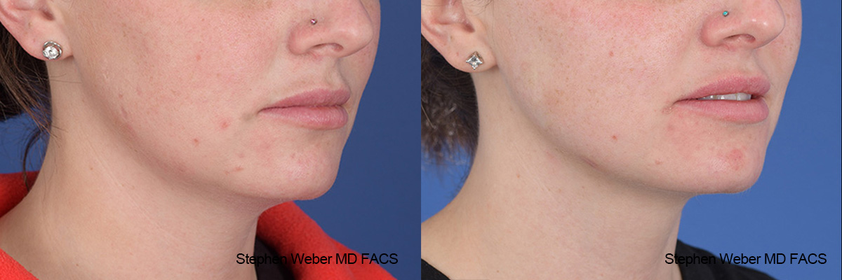 Kybella Before and After | Weber Facial Plastic Surgery