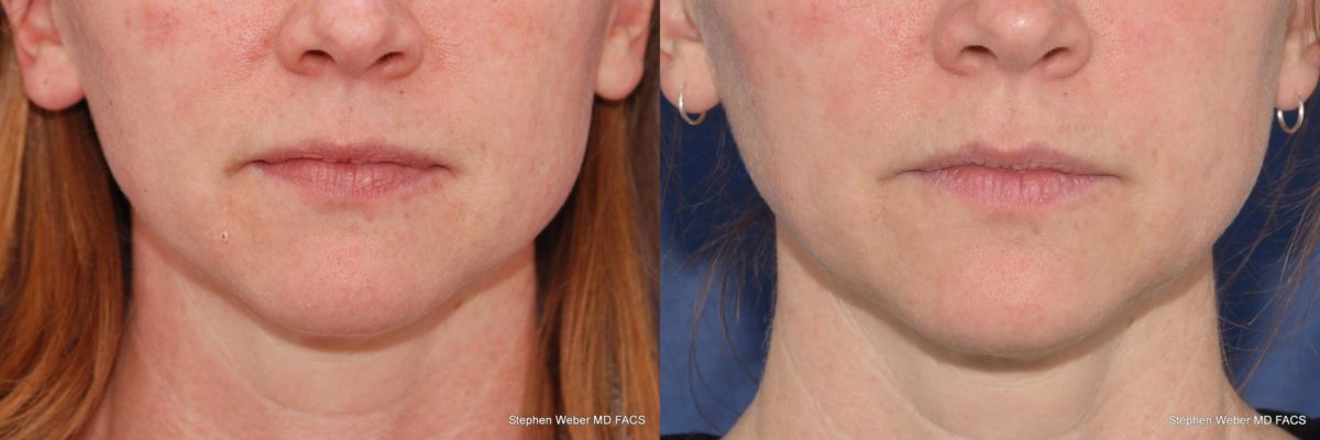 Kybella Before and After | Weber Facial Plastic Surgery